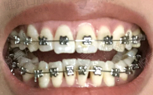 种植牙齿优点有哪些（种植牙的优点缺点）(图1)